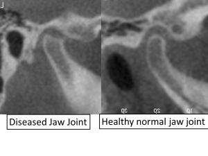 diseased TMJ