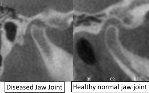 diseased TMJ